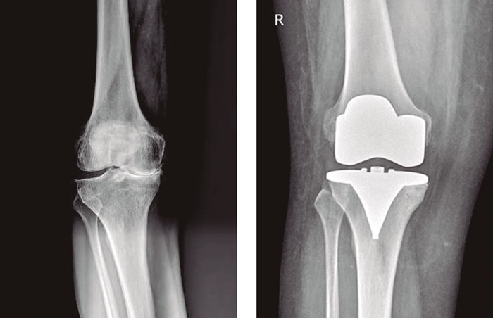 A tu salud: Prótesis de rodilla: un tratamiento para mejorar la calidad de vida