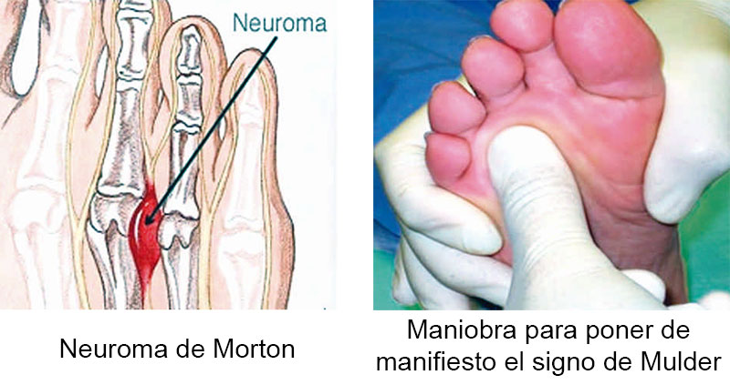A tu salud: Neuroma de Morton: Una enfermedad “Real”