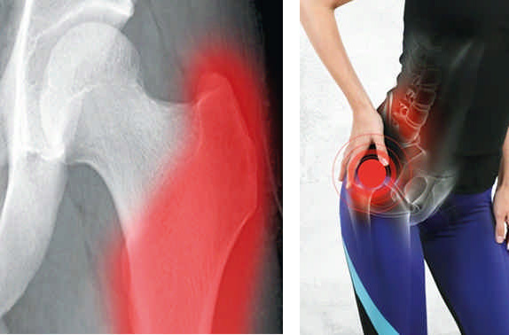 Trocanteritis: El falso dolor de cadera