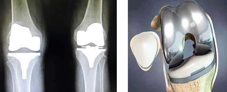 A tu salud: Prótesis de rodilla, dudas frecuentes