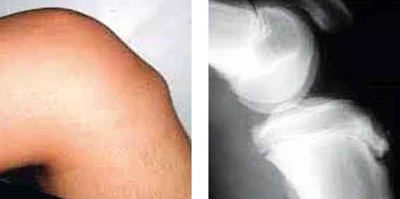 A tu Salud. Enfermedad de Osgood: El dolor del crecimiento
