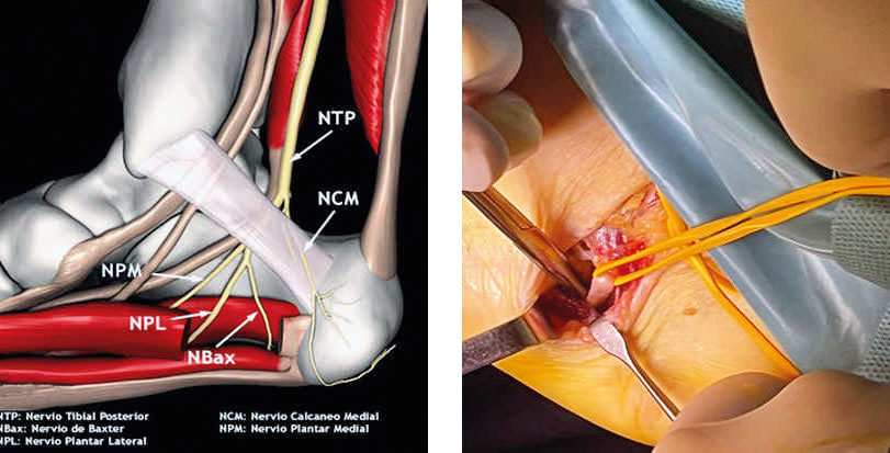 A tu Salud. Neuropatía de Baxter: La falsa fascitis plantar