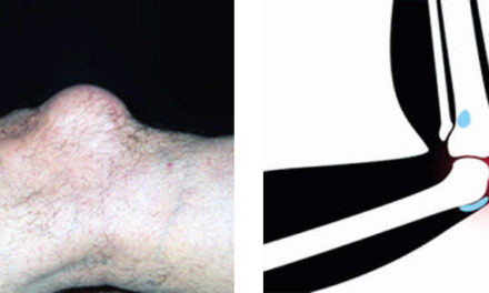 Bursitis Prerrotuliana: La Rodilla de la Beata
