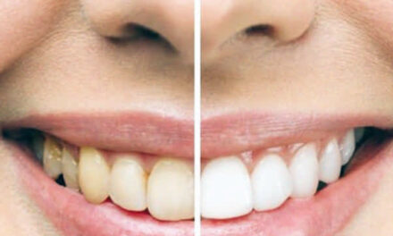 Blanqueamiento dental
